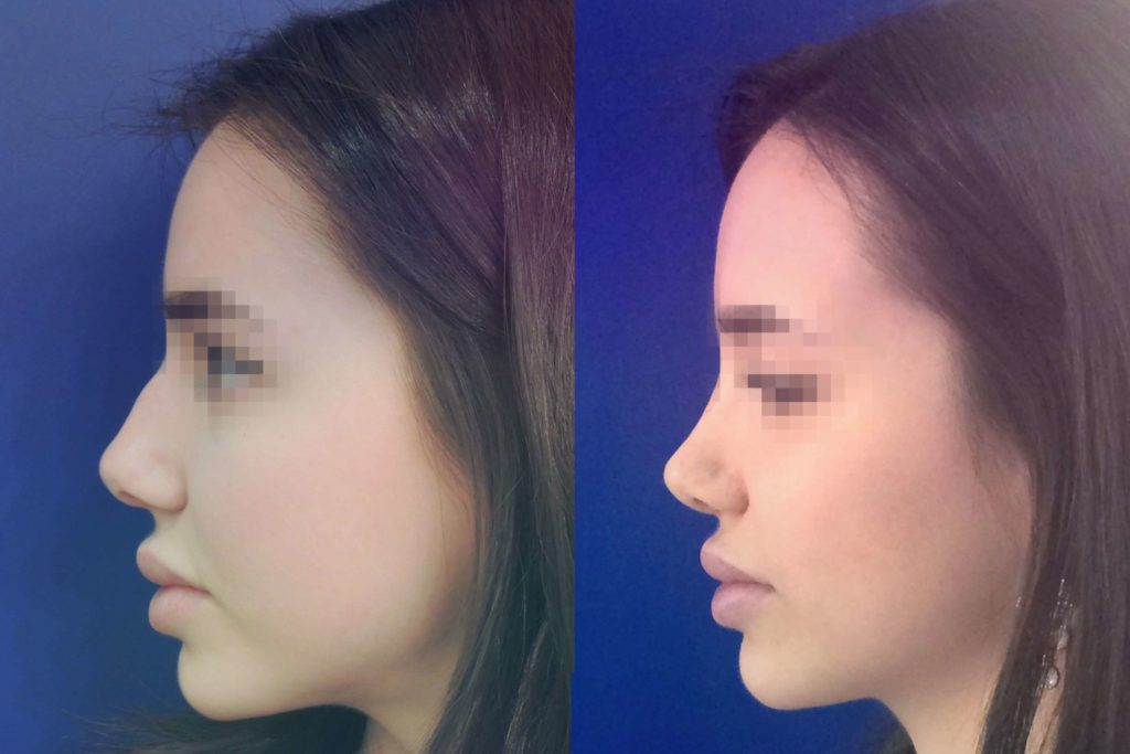 Ринопластика - Идея проектирования